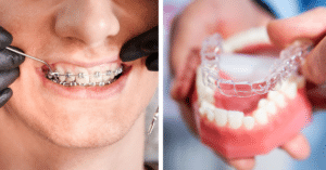 Invisalign vs braces