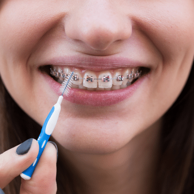 Closeup of a girl's braces while she cleans them, representing how to care for your braces or aligners