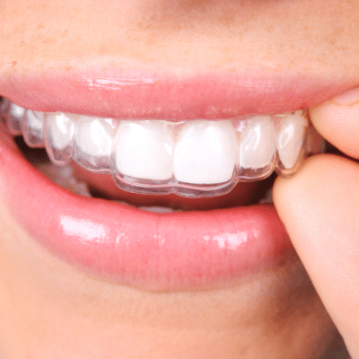 Closeup of a female's mouth while she puts retainer in, representing the importance of wearing a retainer