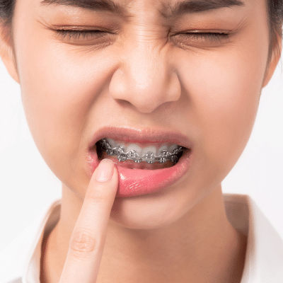Teenage girl with eyes shut, holding finger to lip while in pain, representing managing pain with braces or aligners
