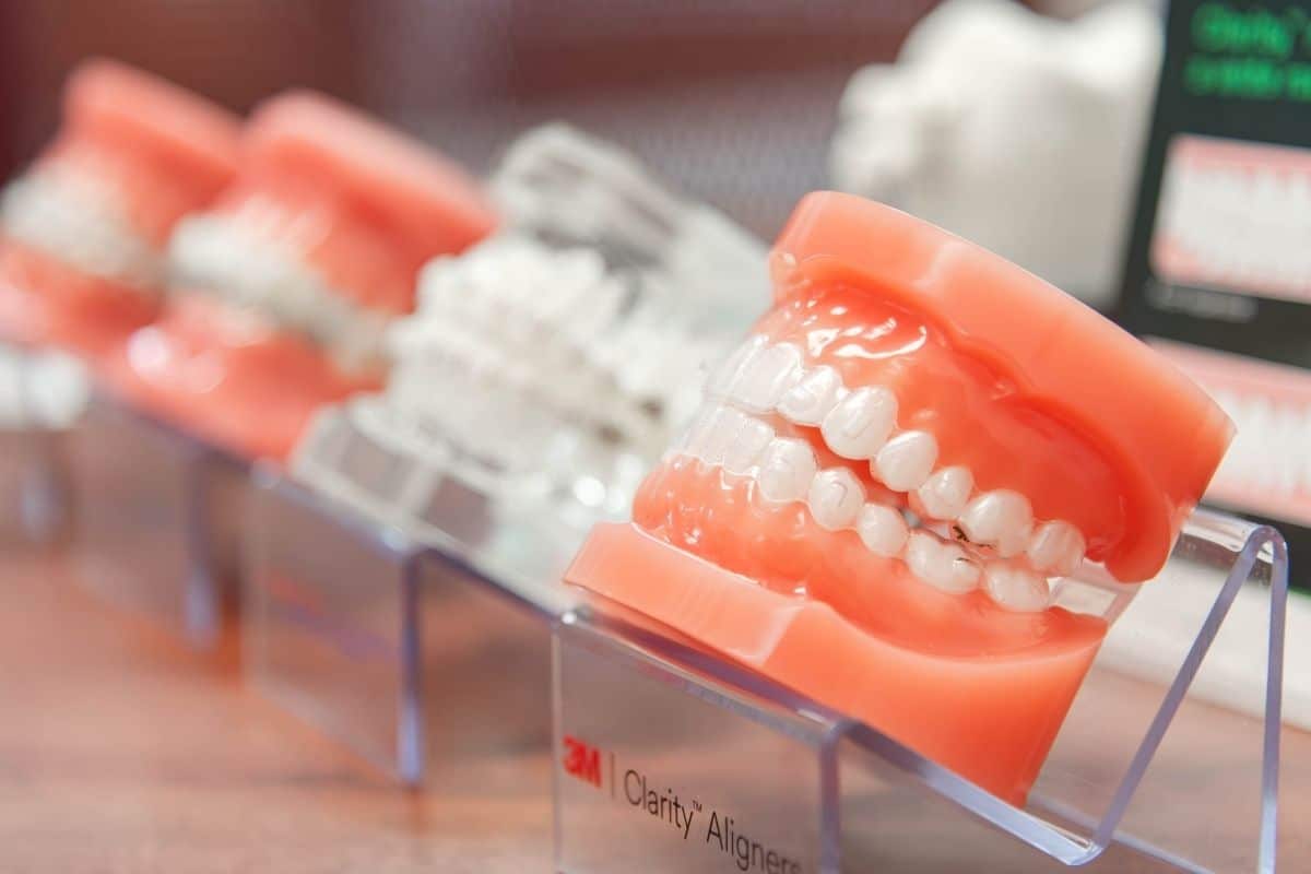 Orthodontic models demonstrating clear aligners and braces at minera orthodontics in warrenton, virginia
